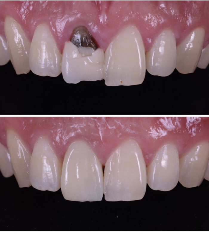before and after broken teeth repair